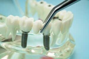dental implants Knoxville